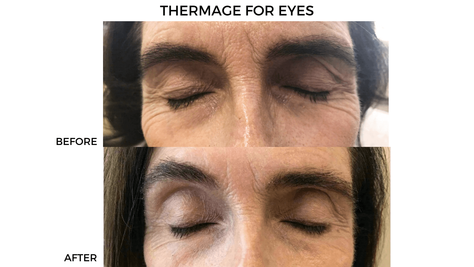 Thermage for Eyes